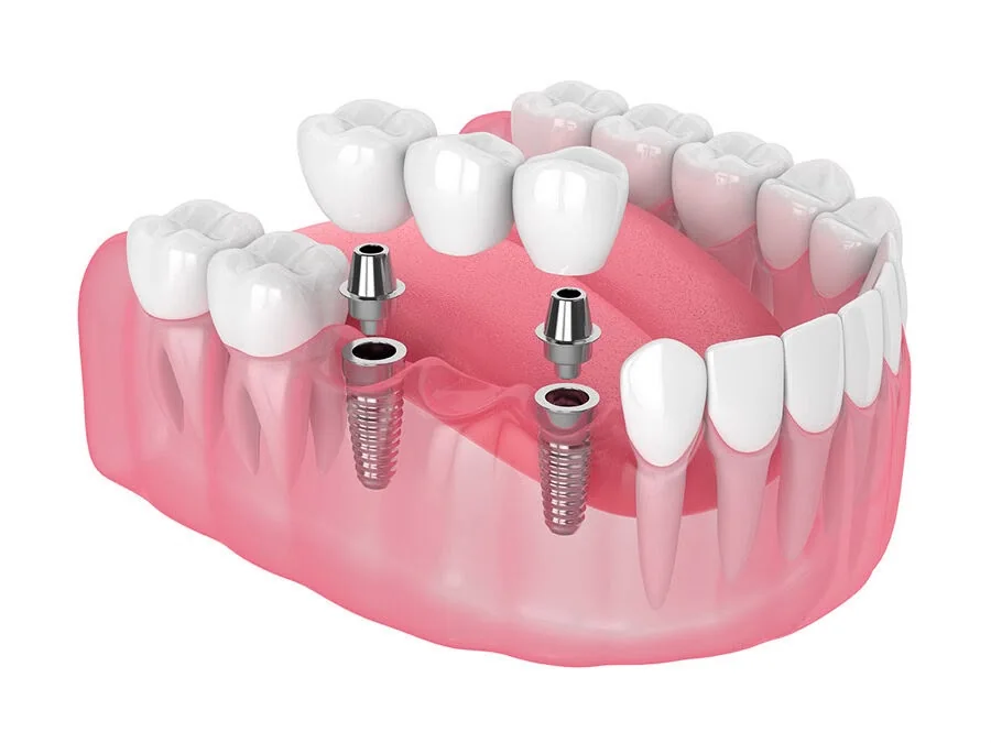 Ilustración de implantes dentales con puente protésico sobre mandíbula