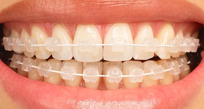 Sonrisa con brackets estéticos de ortodoncia