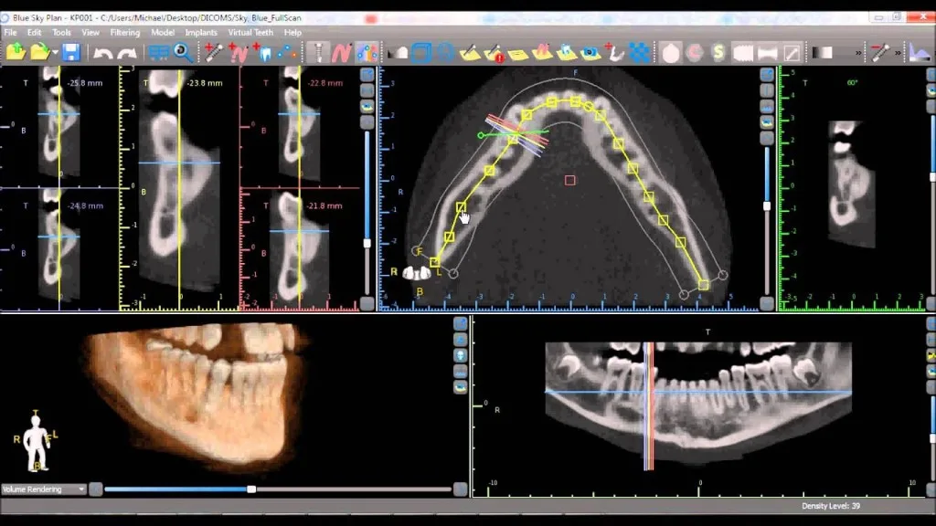 Planificación digital de rehabilitación implanto-protésica en software clínico