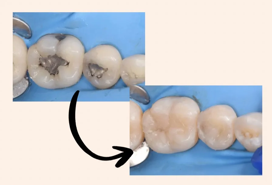 Molares con restauración dental antes y después